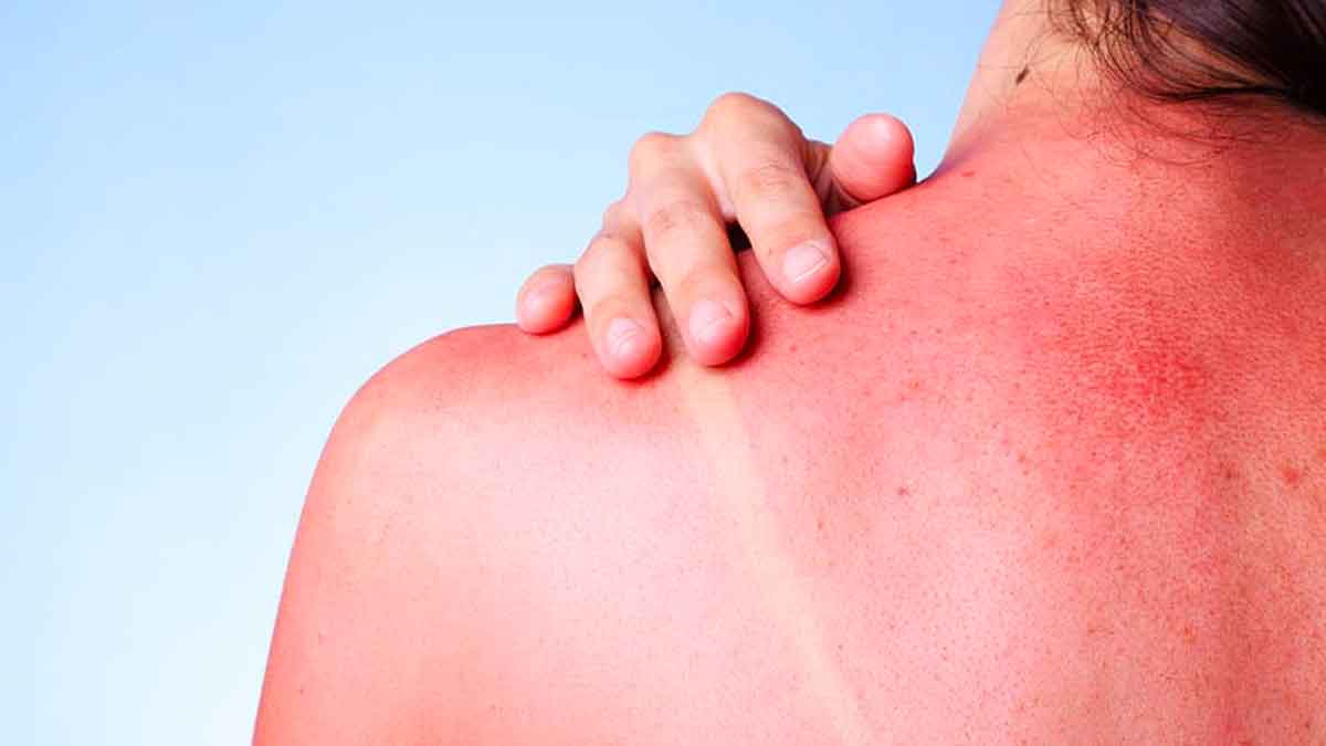 follow these tips if you have sun burn 