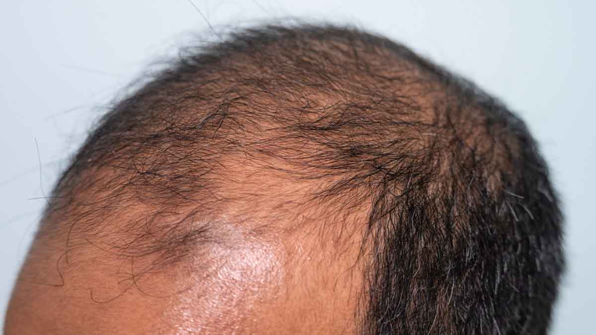 thin hair in men wonderful home remedy 