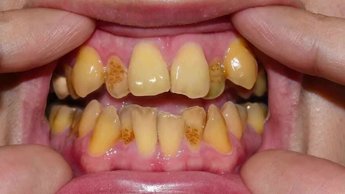 follow these simple health tips to reduce yellow teeth 