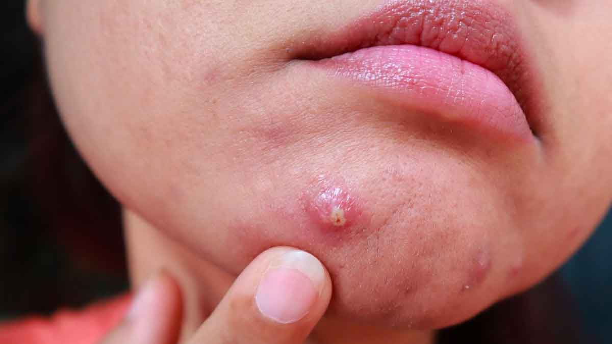 here it is how you can reduce acne with these tips 