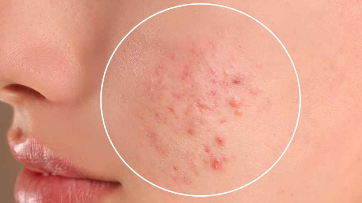 if you eat these foods this will cause acne 