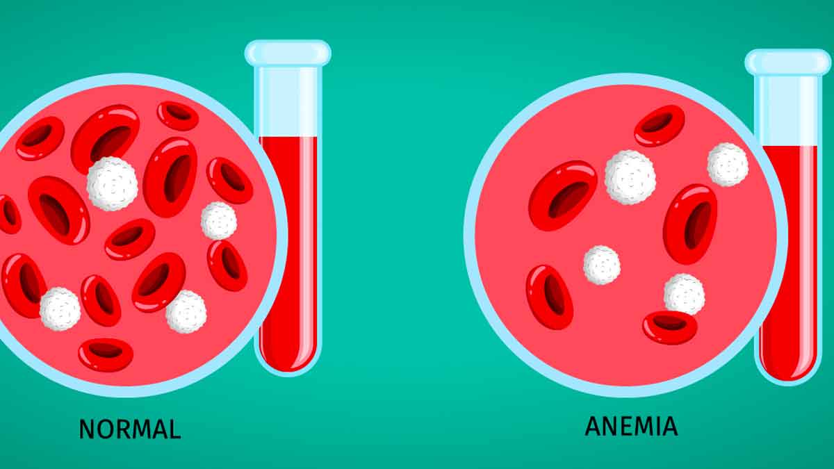 if you have anemia follow these tips 