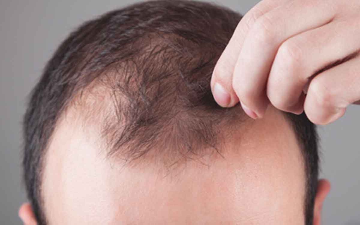 follow these tips to grow hair on bald head 