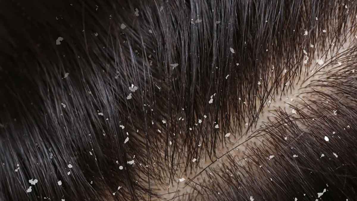 home remedies for dandruff follow these 