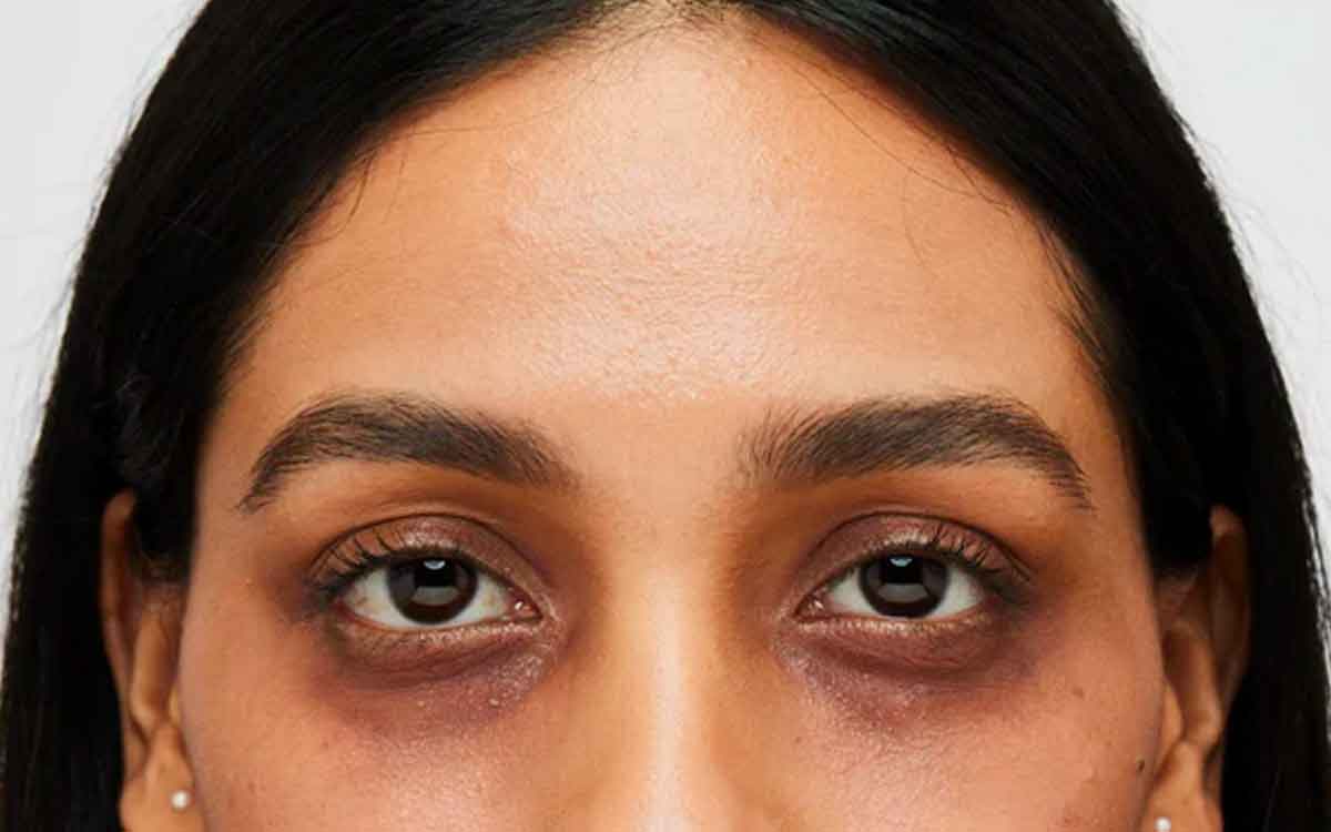 this is how you can remove dark circles 