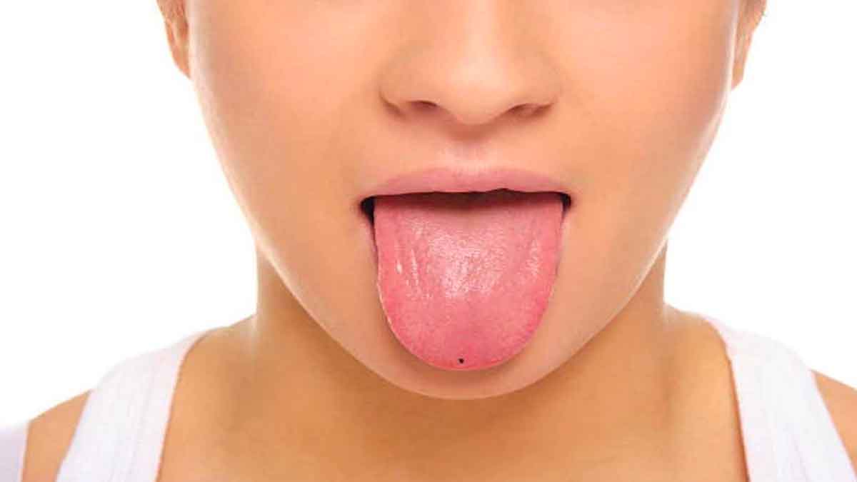 if you have moles on tongue then know what happens 