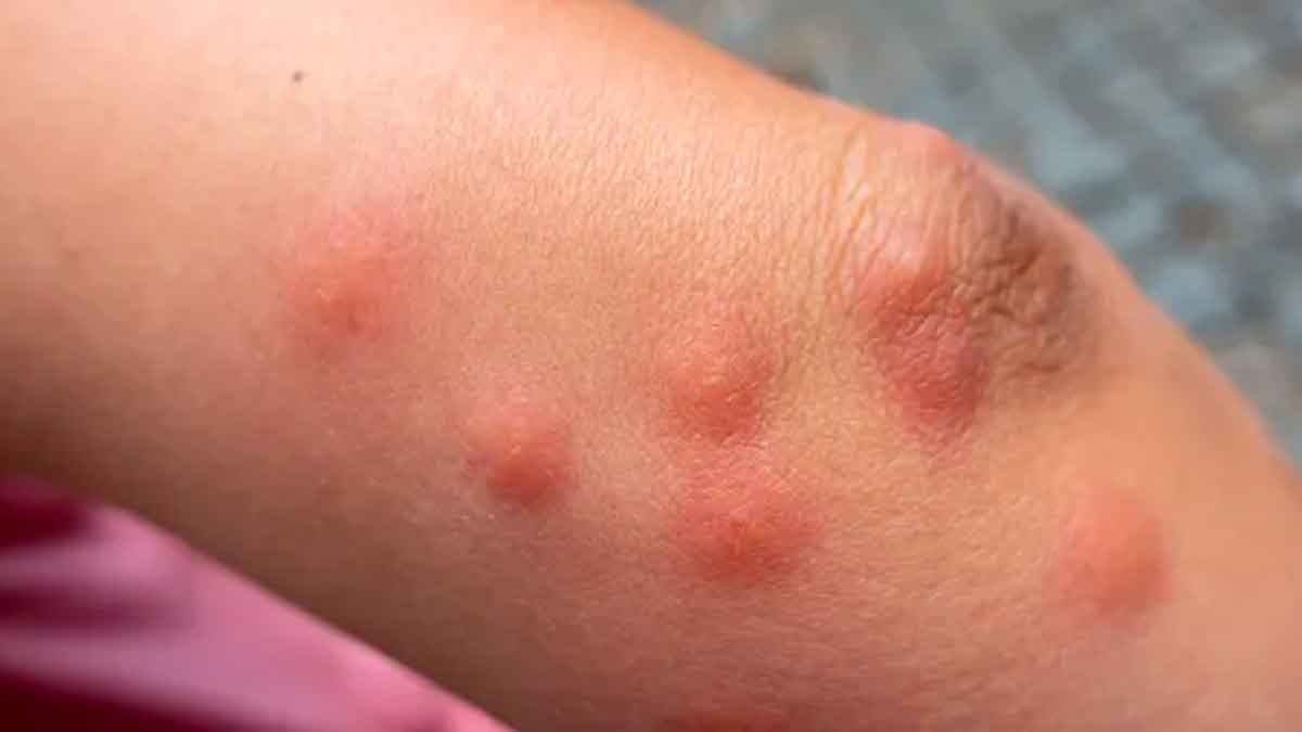 here it is how to remove itching of mosquito bites 