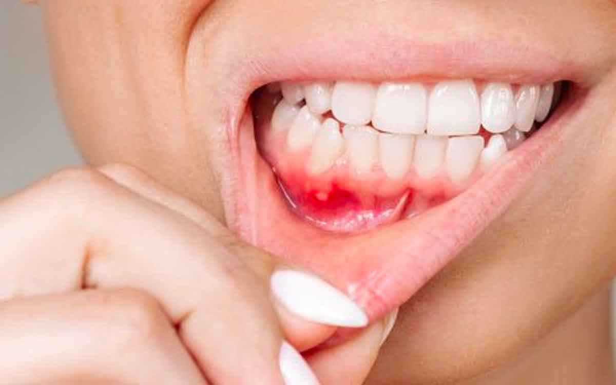 get rid of mouth ulcer with these simple remedies 