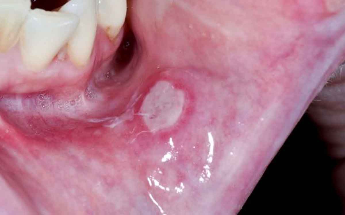 follow these wonderful remedies to reduce mouth ulcer 