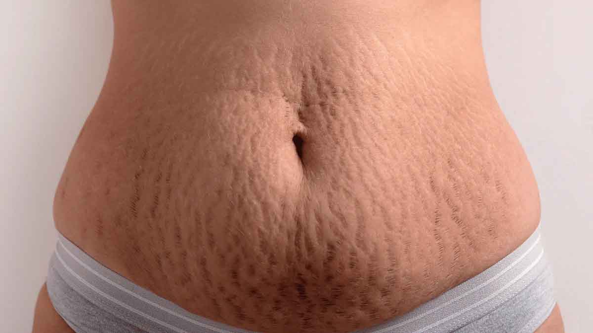 how to remove stretch marks follow these tips 