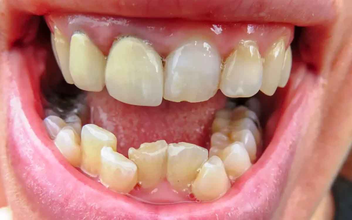 do you know why teeth become weak 