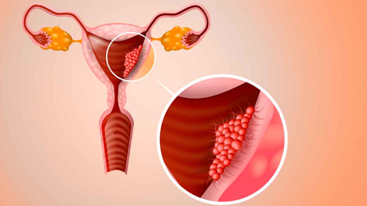 uterus cancer women must know these facts 