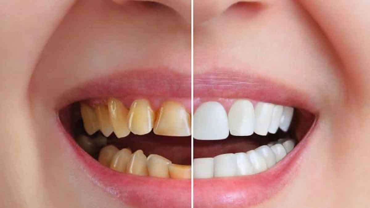 here it is how you can whiten teeth with this tip 