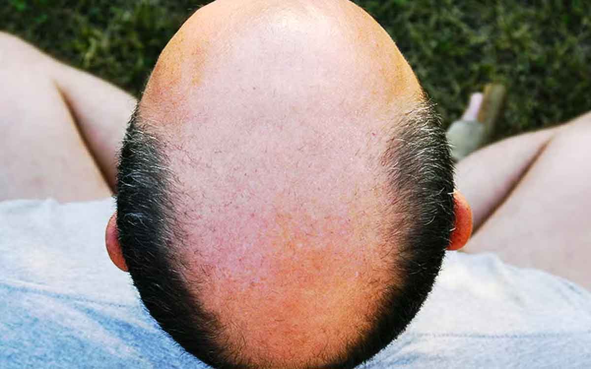 why only men get bald head not women 