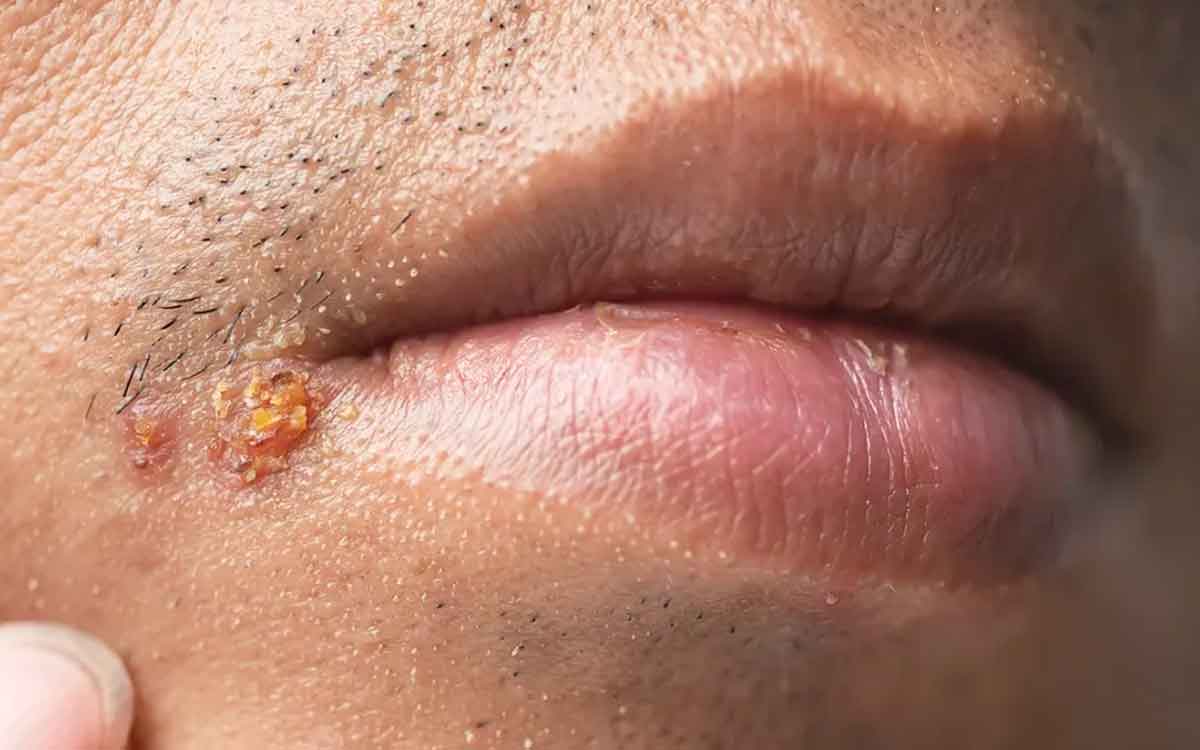 if you have face blisters follow these remedies 