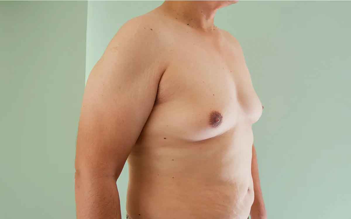 how to reduce breasts in men 