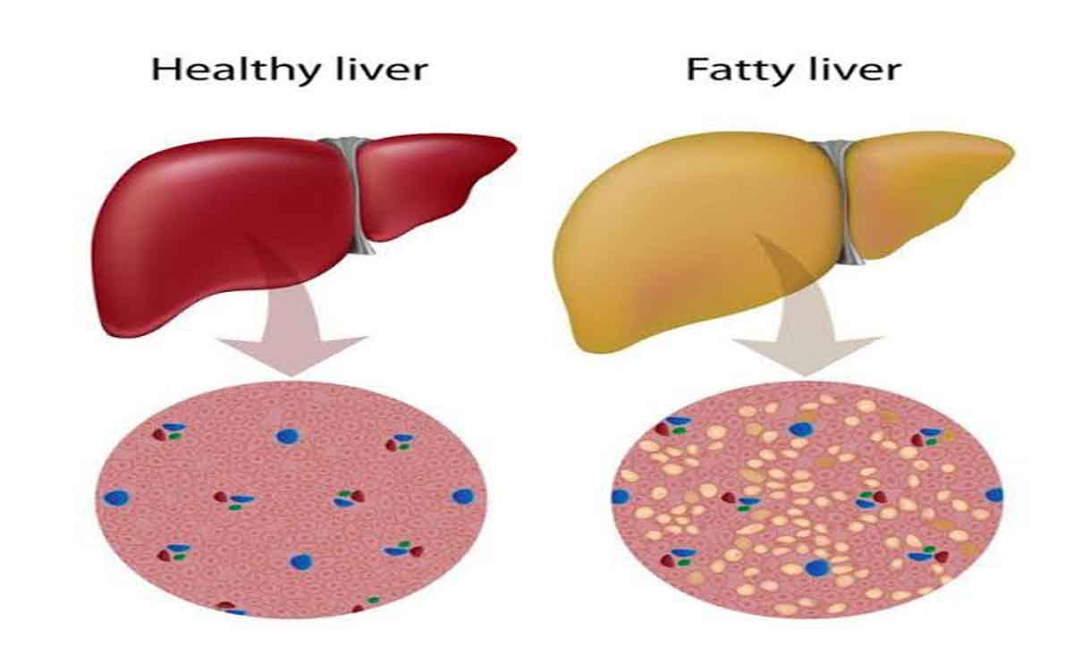 what is fatty liver what are the causes and treatment options 