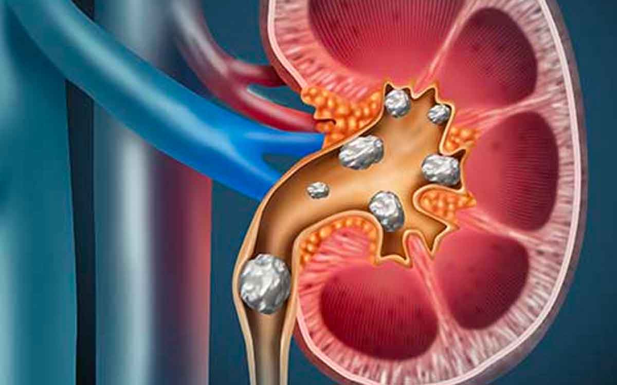 will you get kidney stones if you drink tea coffee excessively 