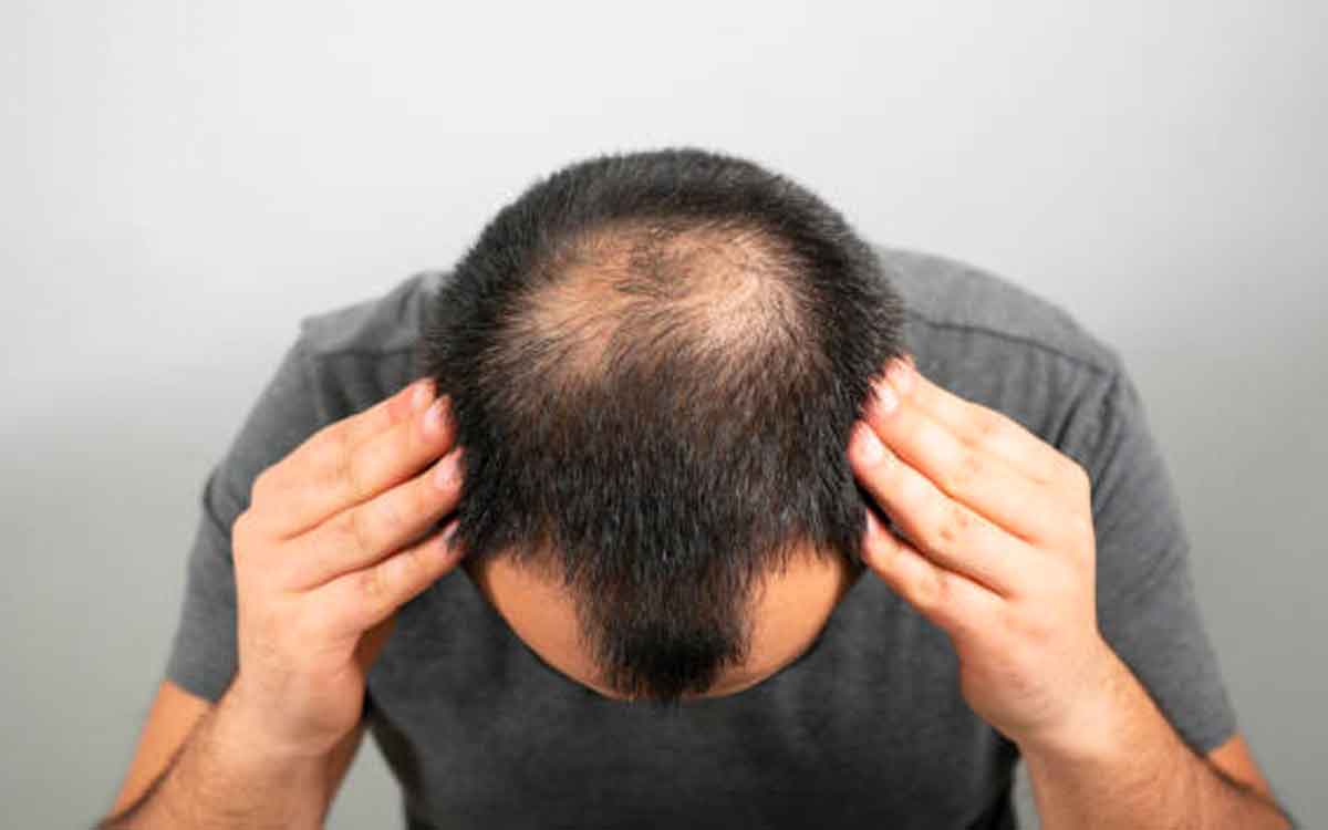 why men only gers bald head