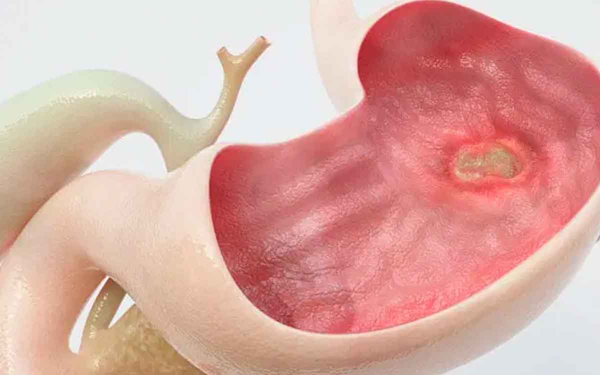 if you are suffering from stomach ulcer do like this 