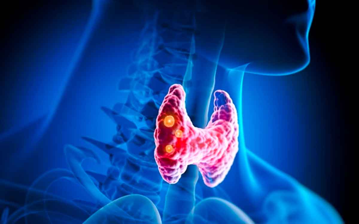 if you are suffering from thyroid follow these tips 