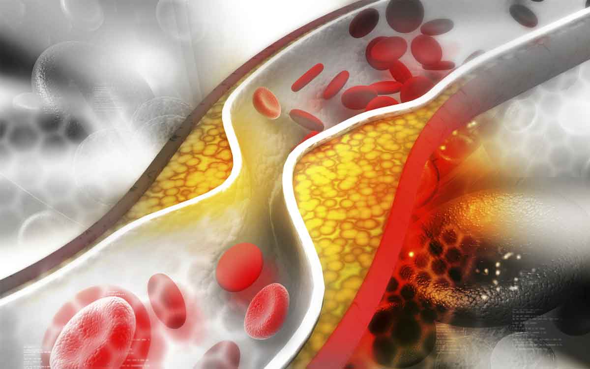 your bones become weak if you have high cholesterol 