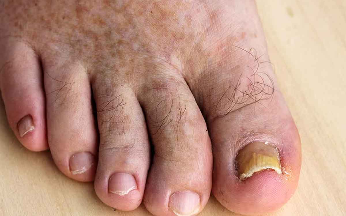 people with diabetes must follow these tips for their feet safety 