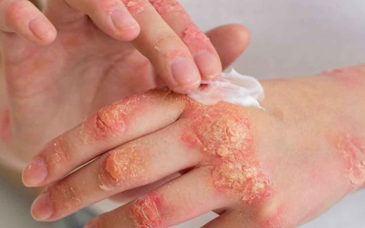 follow these tips to prevent fungal infections in monsoon 