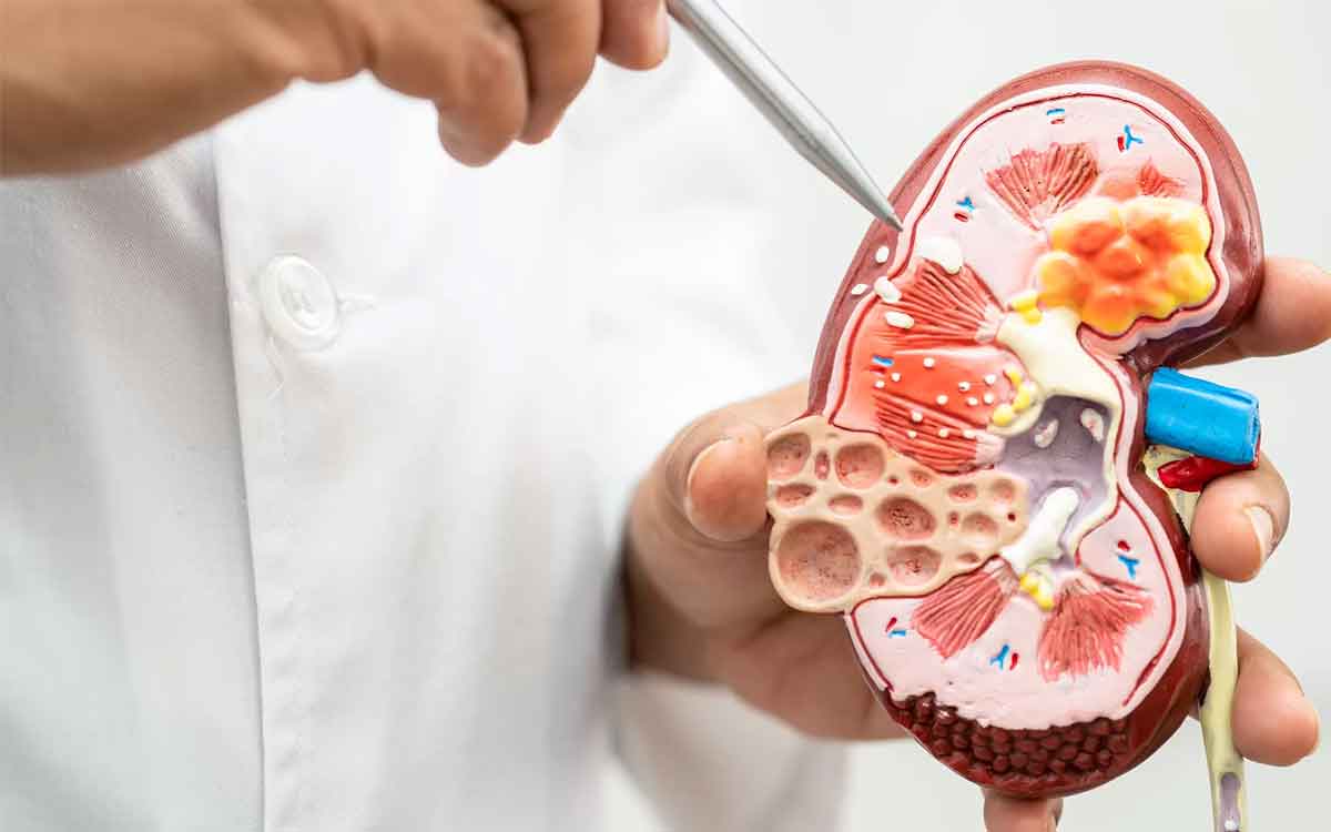 take these foods regularly to remove kidney stones 