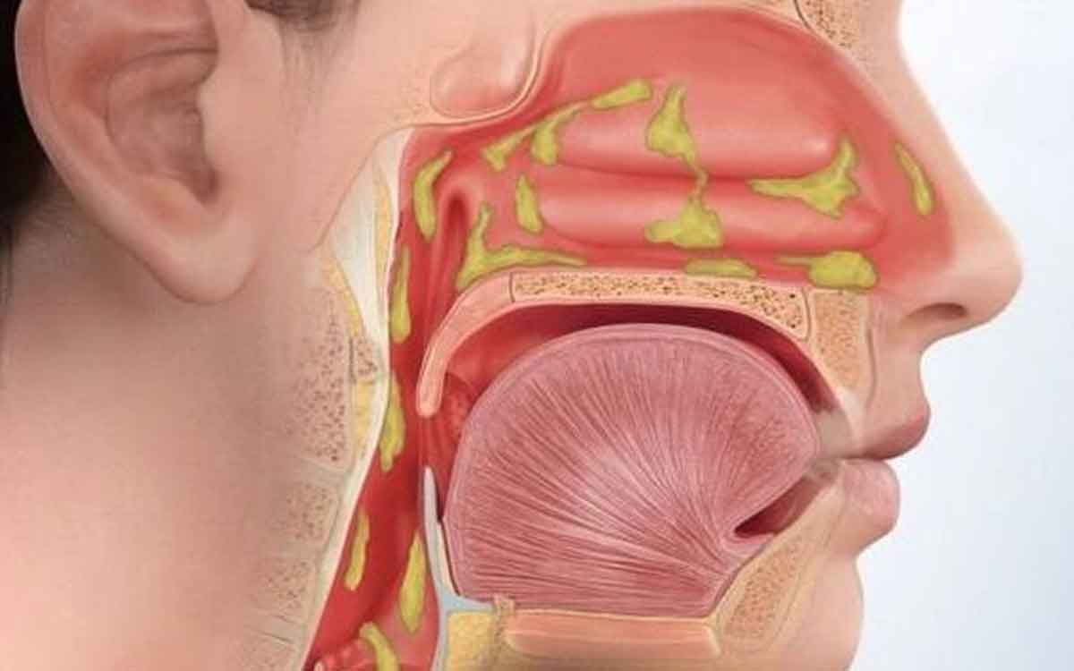 mucus in throat and how to get rid of it 