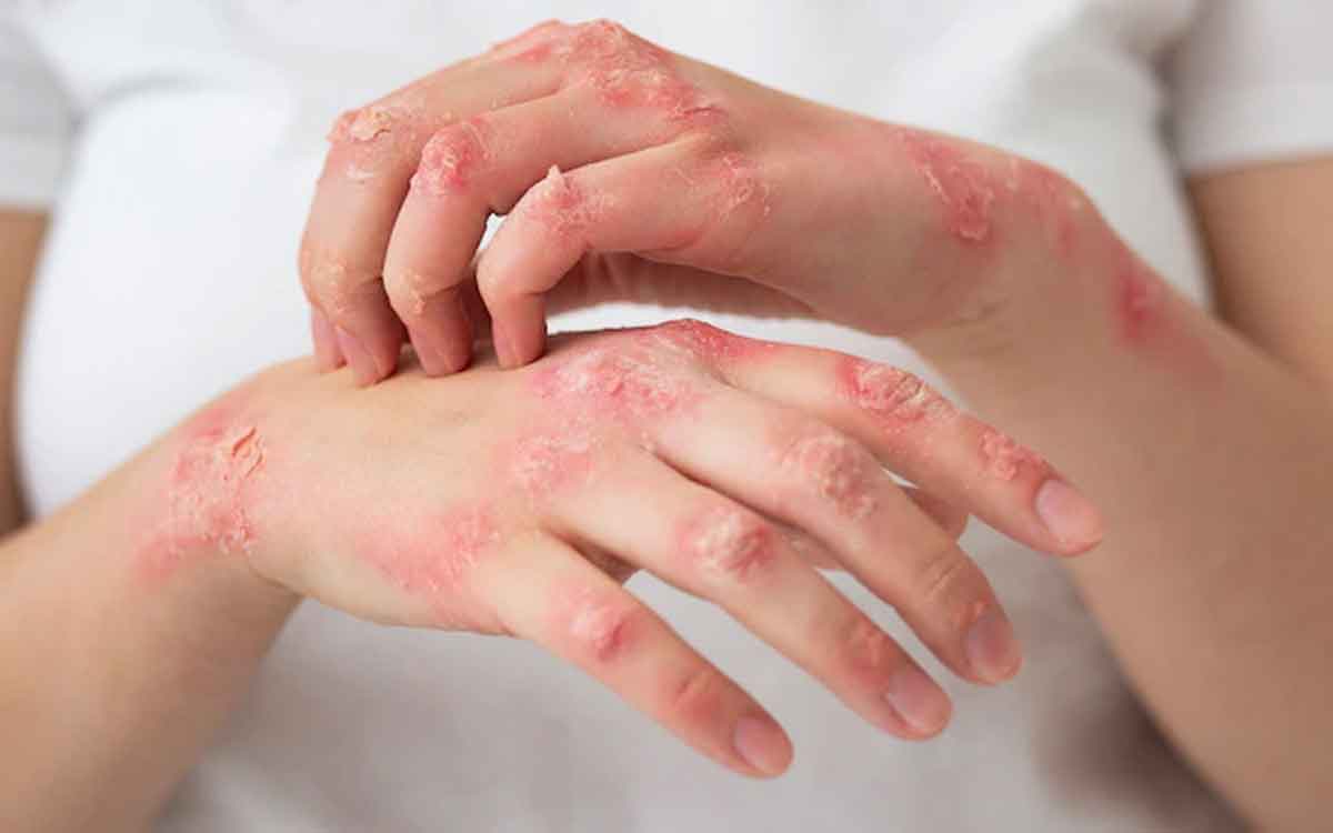 will bolli disease come genetically 