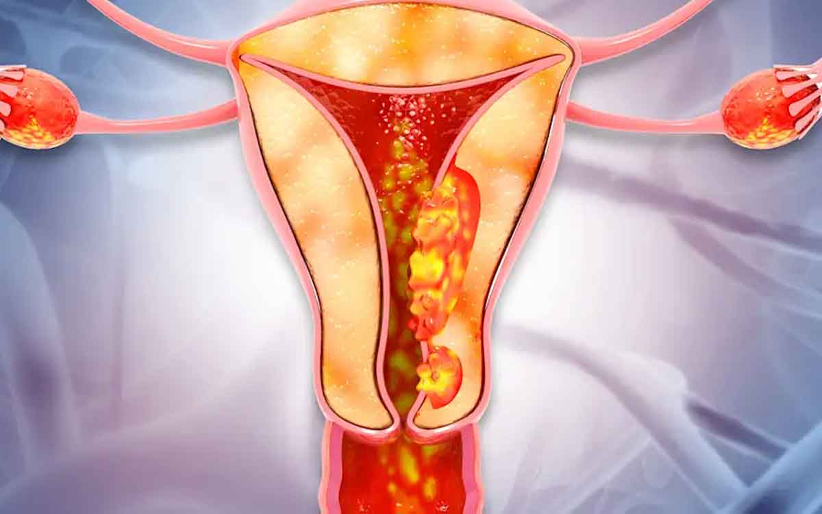 uterus cancer is increasing in indian women these symptoms will appear 